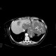 Abdominal sacroma: CT - Computed tomography